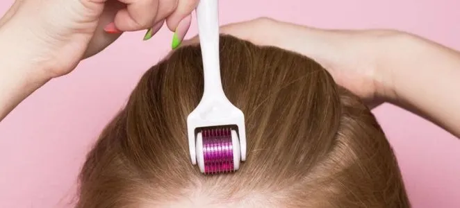 Microneedling to treat hair loss 